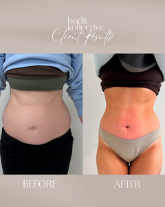 Body Sculpting Combo Packages