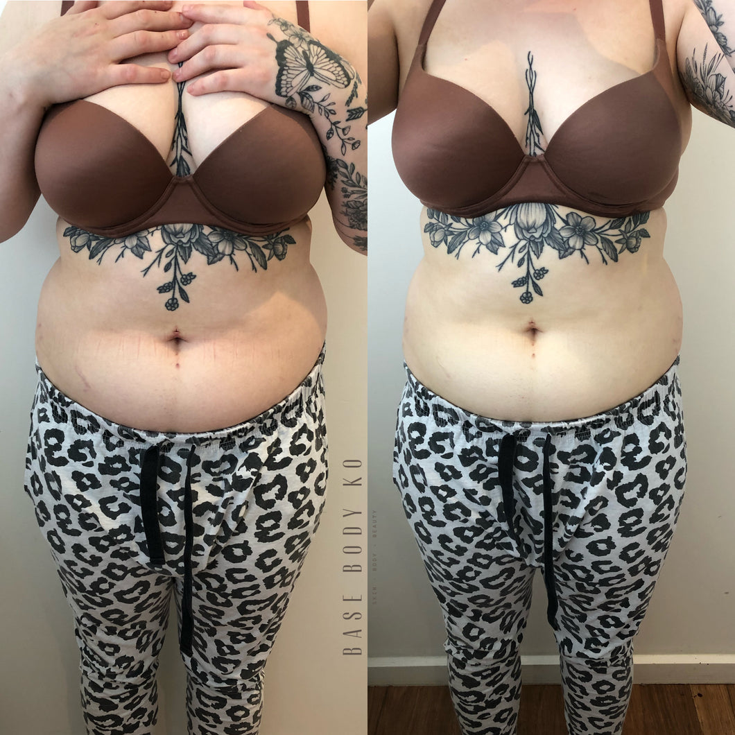 FAT REMOVAL - Pre Pay Packages